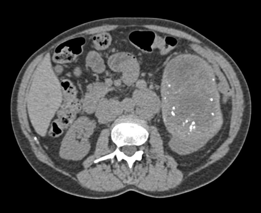 Cystic Renal Cell Carcinoma - CTisus CT Scan