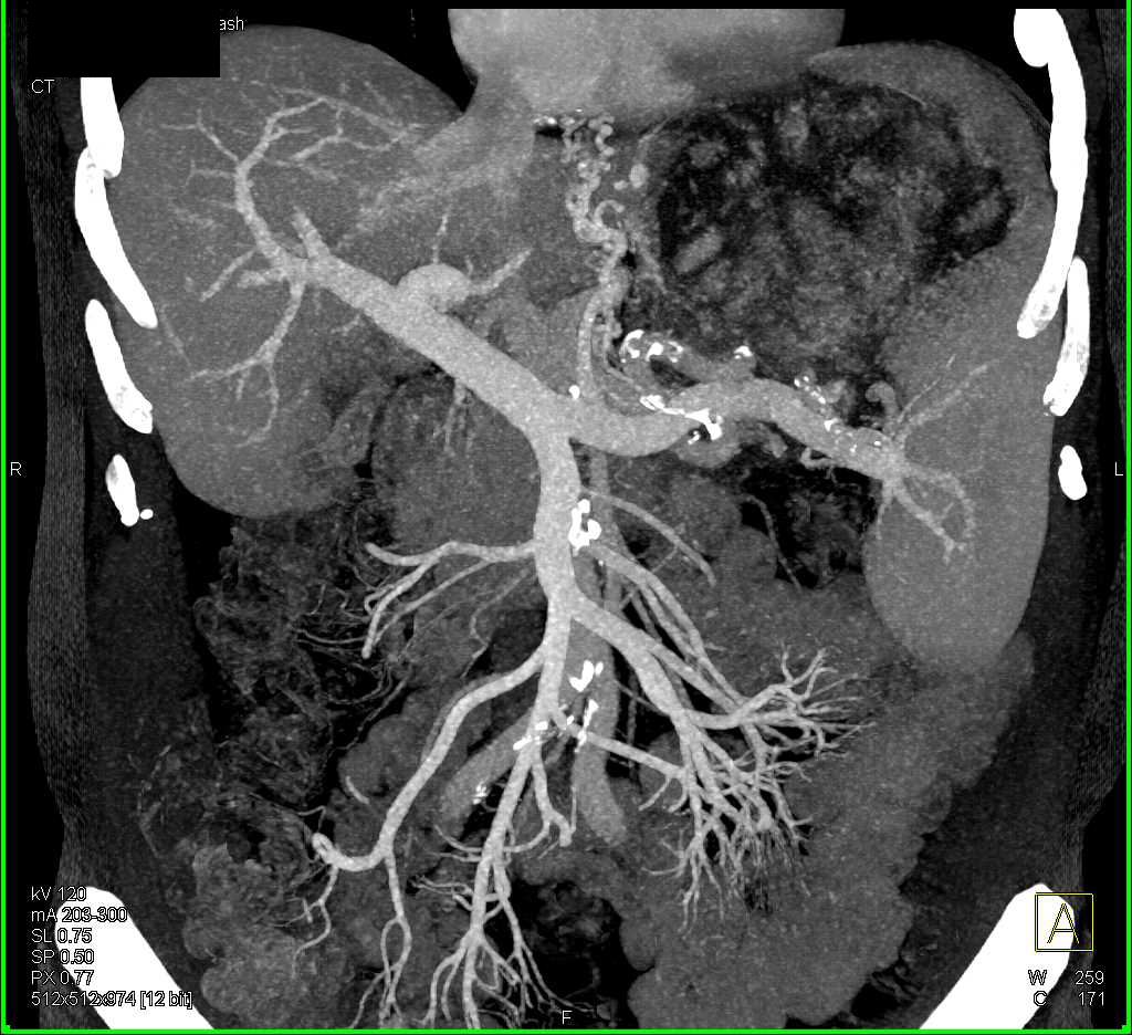 Recurrent Renal Cell Carcinoma in Surgical Bed and to the Liver - CTisus CT Scan