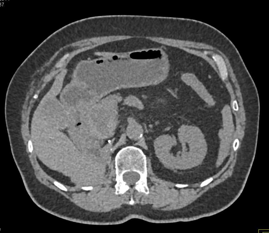 Recurrent Renal Cell Carcinoma in Surgical Bed and to the Liver - CTisus CT Scan