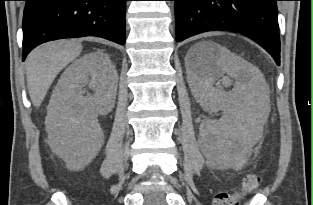 Renal Cell Carcinoma Left Kidney - CTisus CT Scan