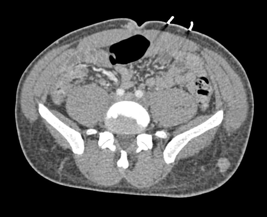 Muscle and Soft Tissue Metastases from Renal Cell Carcinoma - CTisus CT Scan