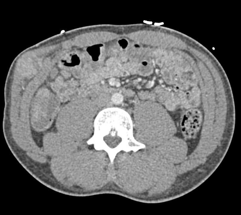 Metastatic Renal Cell Carcinoma to the Contralateral Kidney and Muscle in Right Flank - CTisus CT Scan