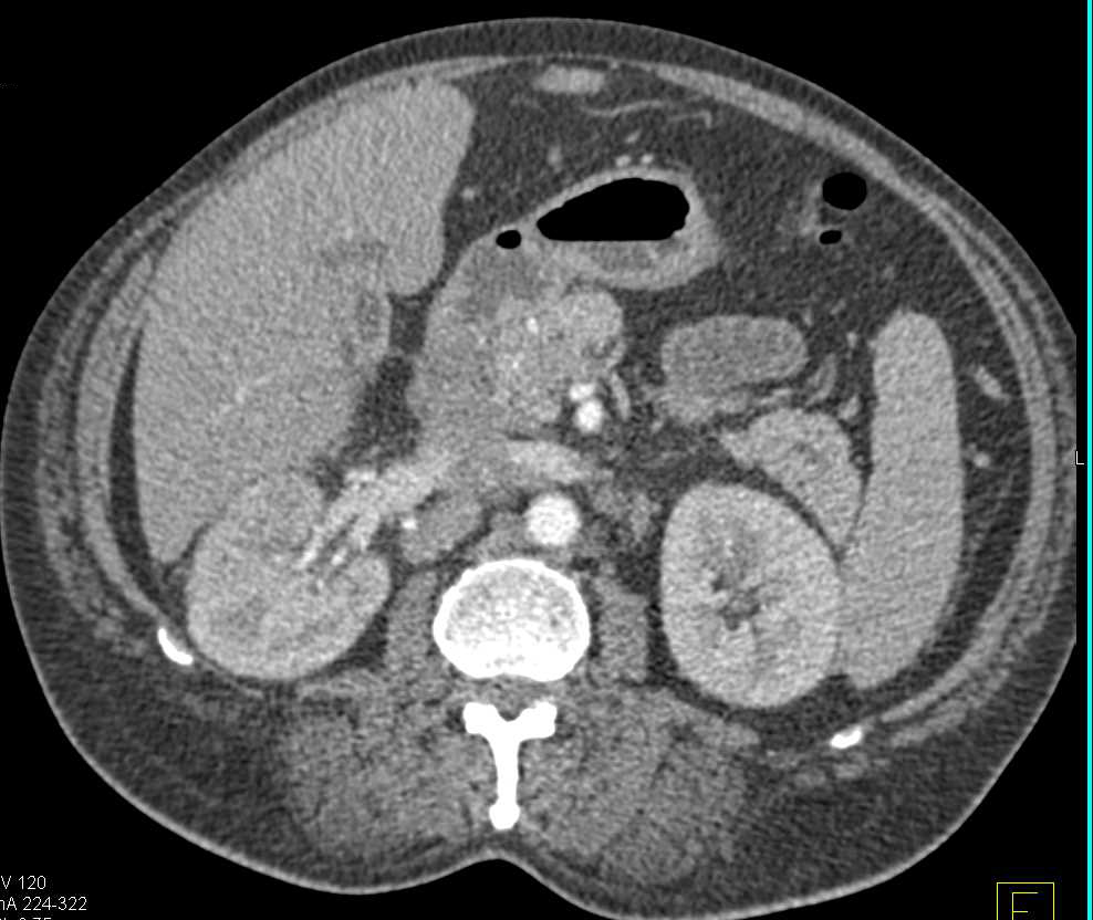 Acute Pyelonephritis Right Kidney - CTisus CT Scan