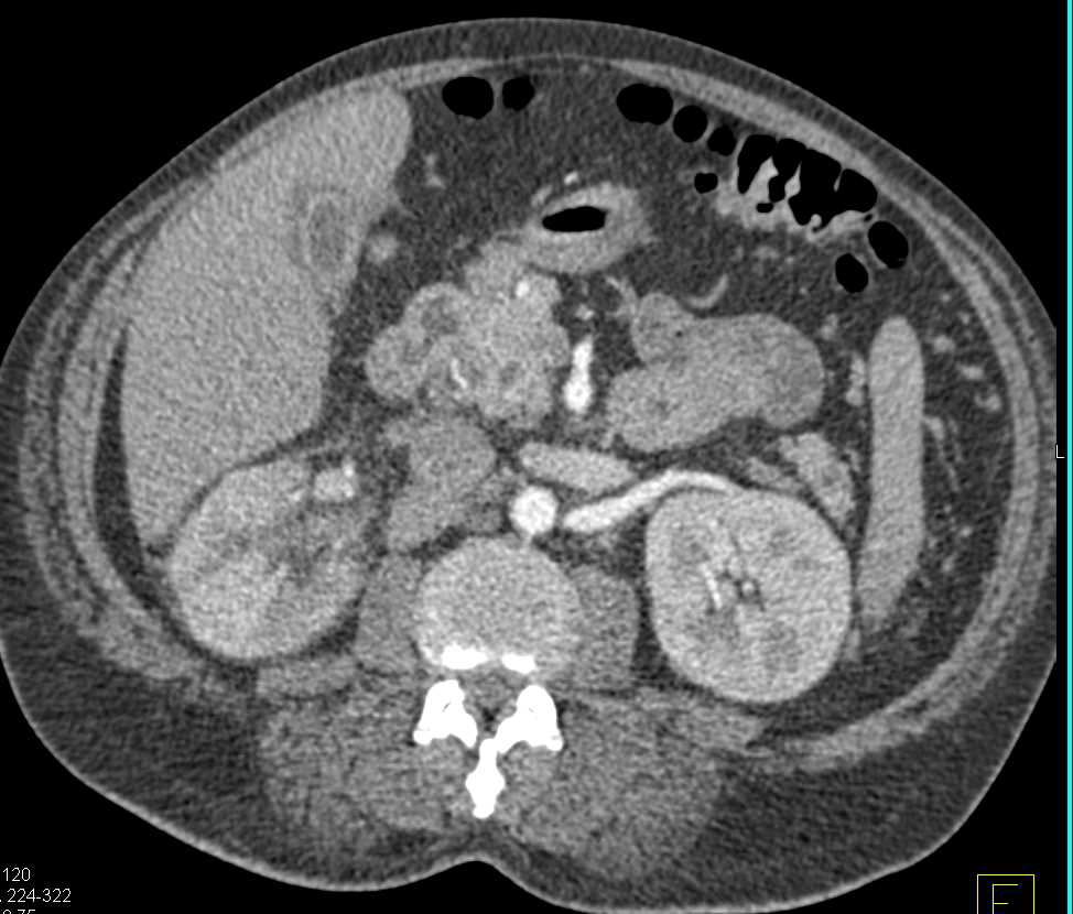 Acute Pyelonephritis Right Kidney - CTisus CT Scan