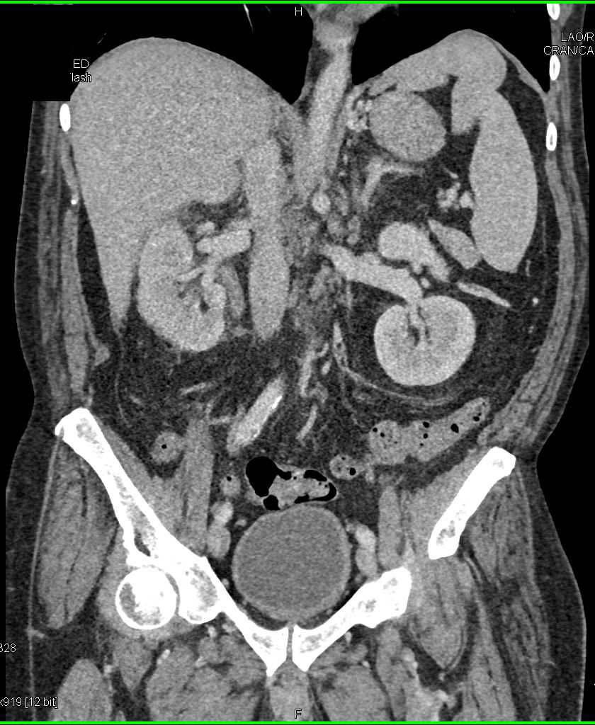 Acute Pyelonephritis Right Kidney Kidney Case Studies Ctisus Ct