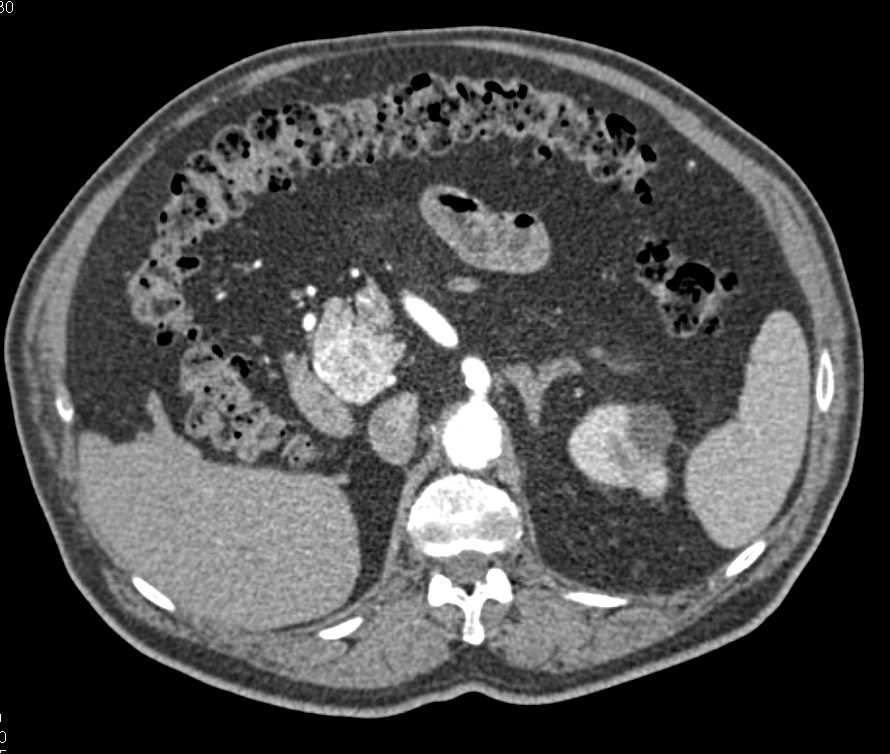 Metastatic Renal Cell Carcinoma to the Pancreas and Lung - CTisus CT Scan