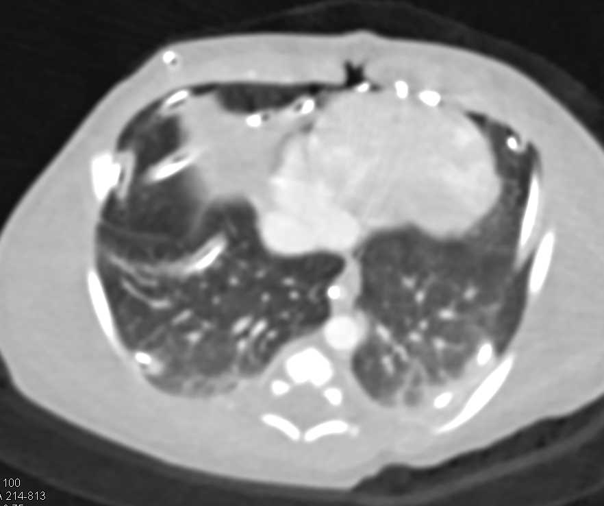 Infarcted Left Kidney - CTisus CT Scan