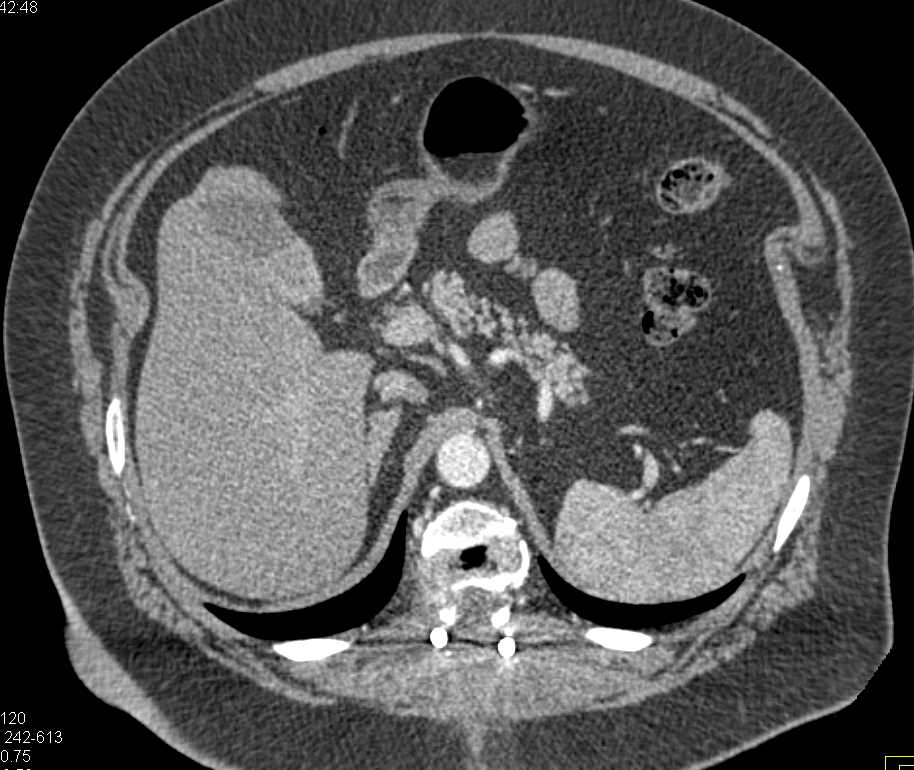 Vascular Metastases to the Liver, Bone and Muscle from Renal Cell Carcinoma - CTisus CT Scan