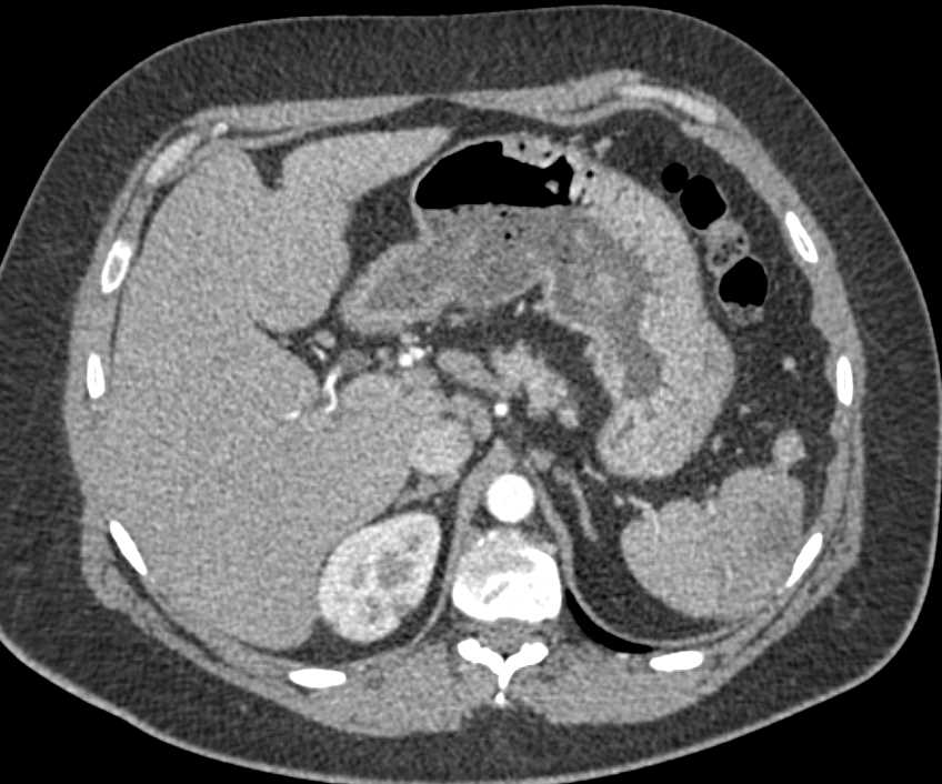 Acute Pyelonephritis Right Kidney - CTisus CT Scan