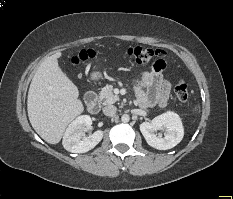 Acute Pyelonephritis Right Kidney - Kidney Case Studies - CTisus CT