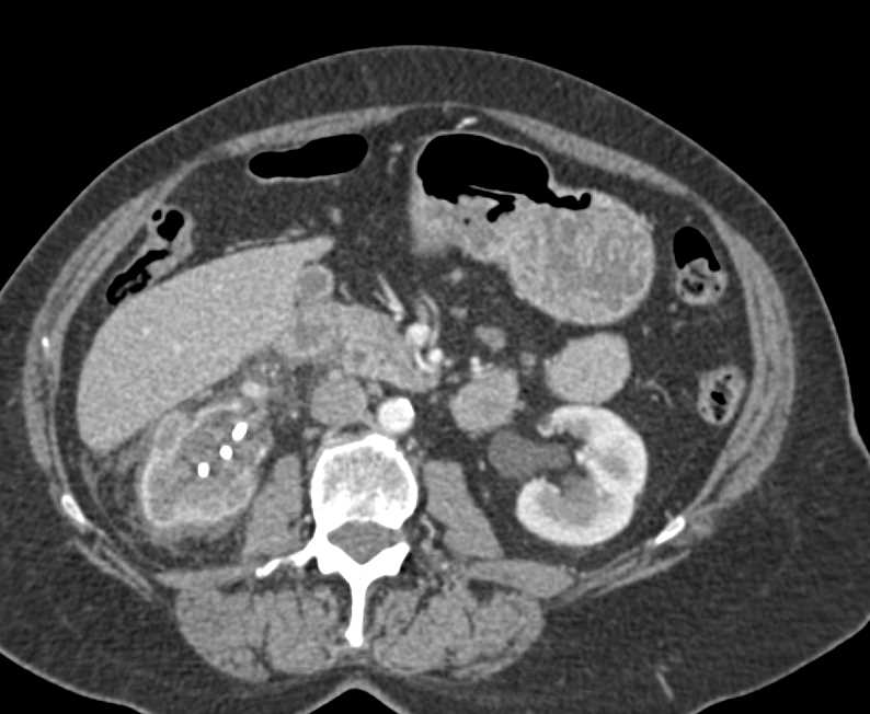 Transitional Cell Cancer (TCC) of the Right Ureter with Stent in Place - CTisus CT Scan