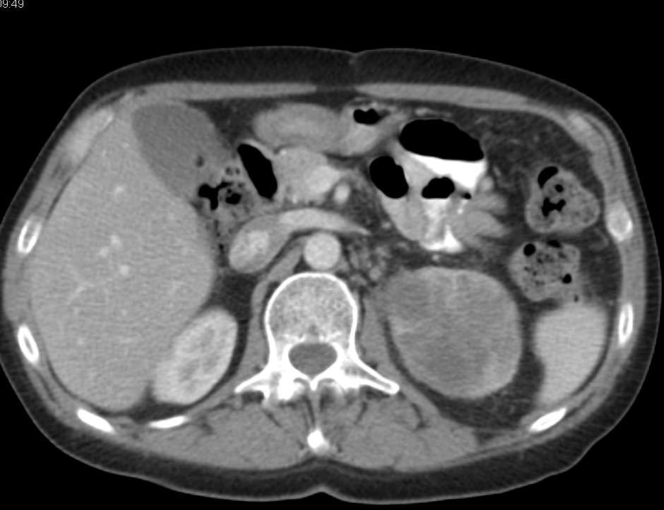 Transitional Cell Carcinoma Infiltrates the Left Kidney - CTisus CT Scan