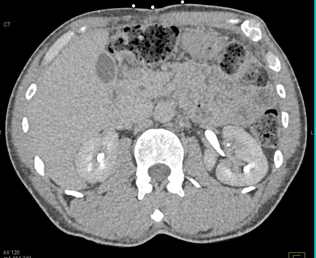 Bullet Lodged in the Right Kidney - CTisus CT Scan