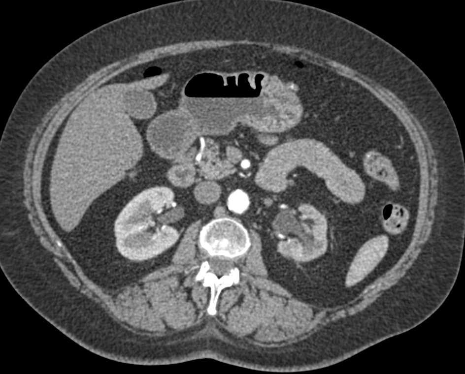 Transitional Cell Cancer (TCC) Distal Left Ureter - CTisus CT Scan