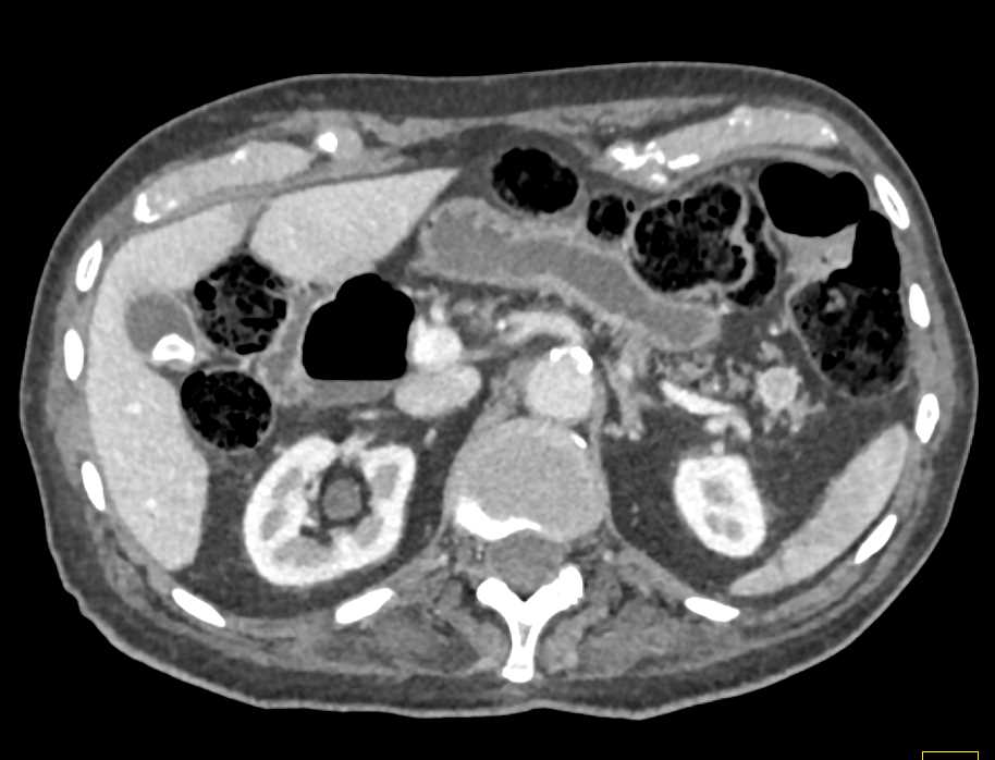 Obstructed Right Ureter and Renal Pelvis - CTisus CT Scan