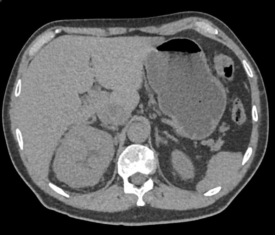 Infiltrating Renal Cell Carcinoma Right Kidney - CTisus CT Scan