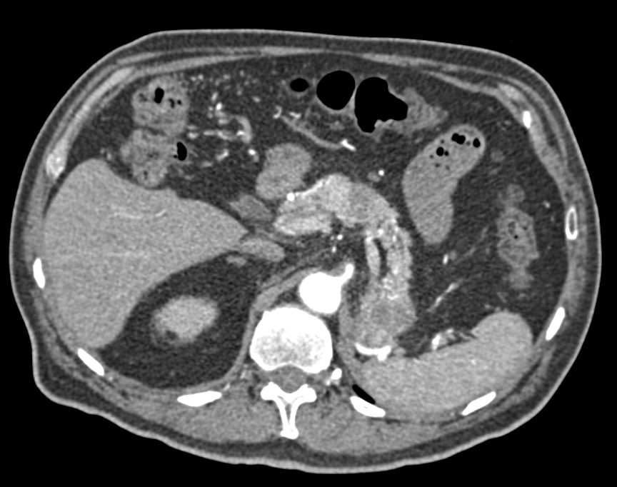 Recurrent Renal Cell Carcinoma Metastatic to the Pancreas - CTisus CT Scan