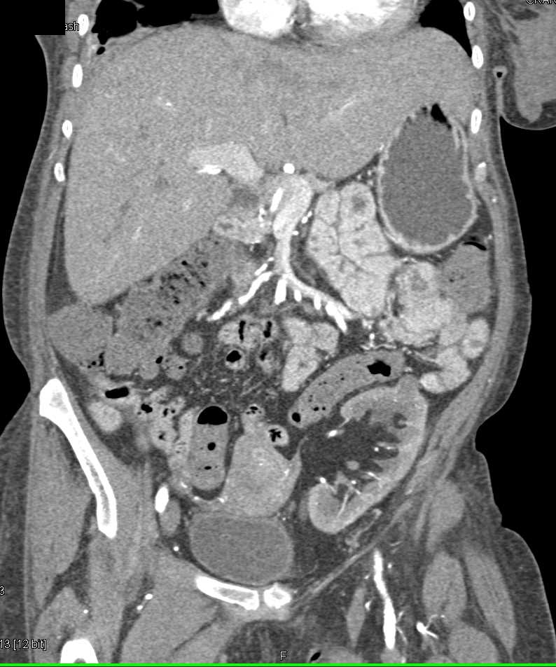 Renal Cell Carcinoma in a Transplant Kidney - CTisus CT Scan