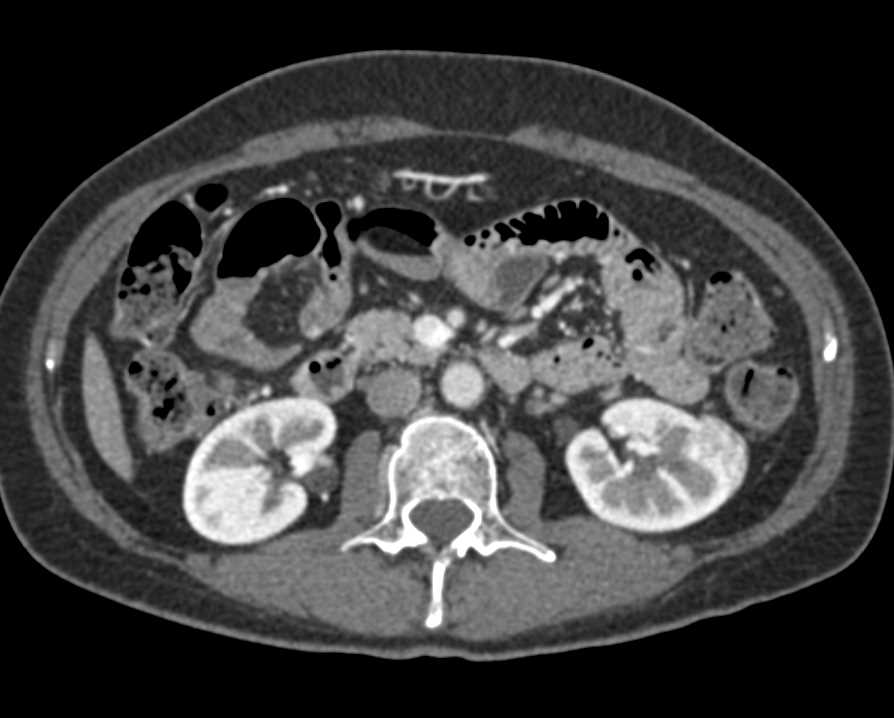 Left Renal Angiomyolipoma with Minimal Fat - CTisus CT Scan