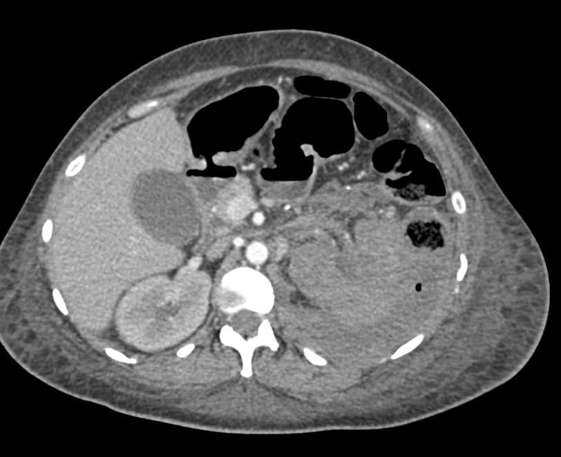 Infarcted Left Kidney with Bleed - CTisus CT Scan