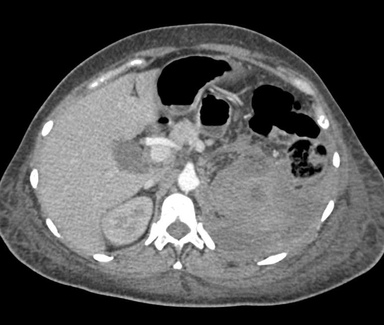 Infarcted Left Kidney with Bleed - CTisus CT Scan