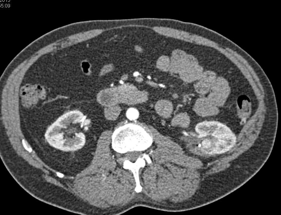 Pseudoaneurysm at the Site of a Partial Nephrectomy Simulates a Recurrence - CTisus CT Scan