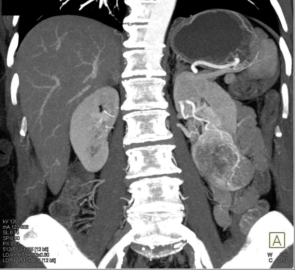 Papillary Renal Cell Carcinoma - CTisus CT Scan