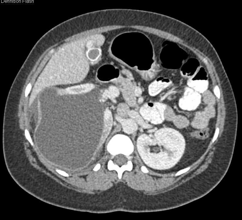 Bosniak 2F Renal Cyst - CTisus CT Scan