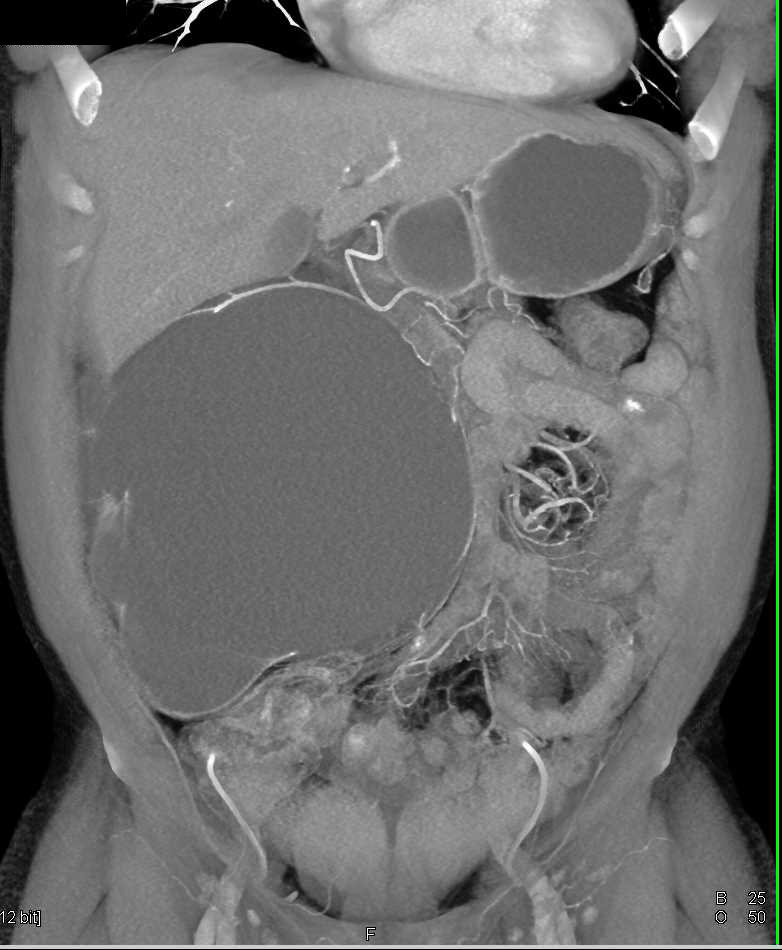 Chronic Right Ureteropelvic Junction (UPJ) Obstruction with Marked Loss of Cortex of the Right Kidney - CTisus CT Scan