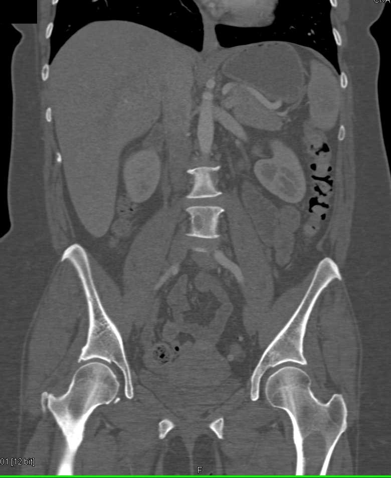 Renal Cell Carcinoma in the Lower Pole of the Left Kidney - CTisus CT Scan