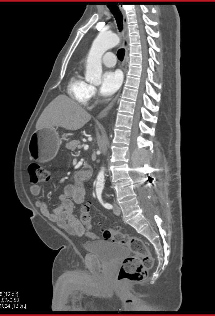 Metastatic Renal Cell Carcinoma to Bone - CTisus CT Scan