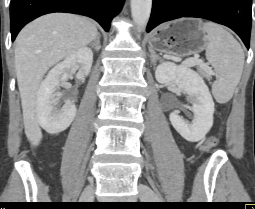 Subtle Transitional Cell Cancer (TCC) Right Ureter - CTisus CT Scan