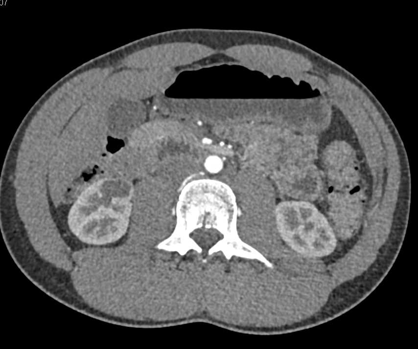 Calyceal Diverticulum Right Kidney - Kidney Case Studies - CTisus CT ...