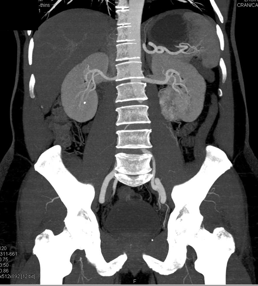 Renal Cell Carcinoma in the Left Kidney - CTisus CT Scan