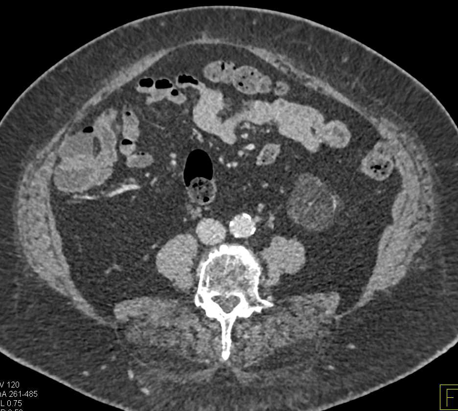 Angiomyolipoma (AML) Left Kidney - CTisus CT Scan