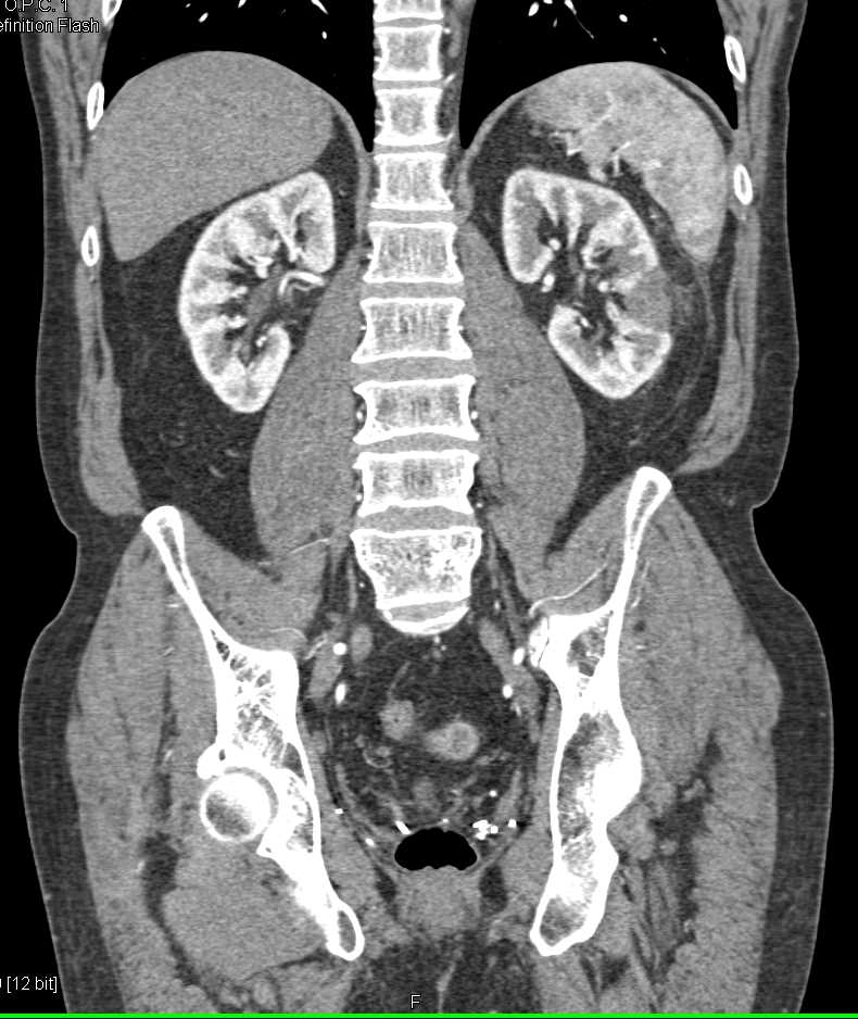 Post Ablation Changes Left Kidney - CTisus CT Scan