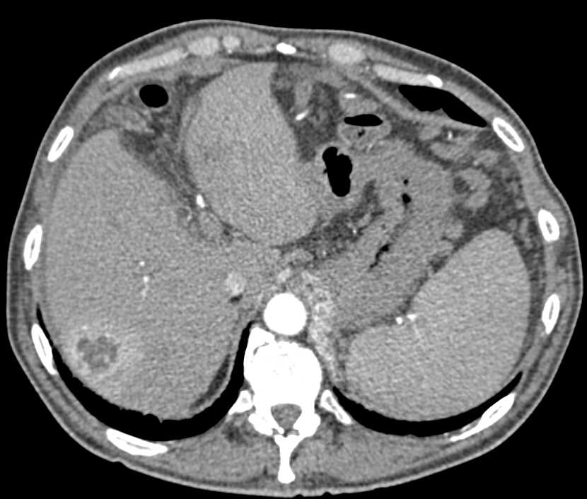 Recurrent Renal Cell Carcinoma with Local Recurrence and Liver Metastases - CTisus CT Scan