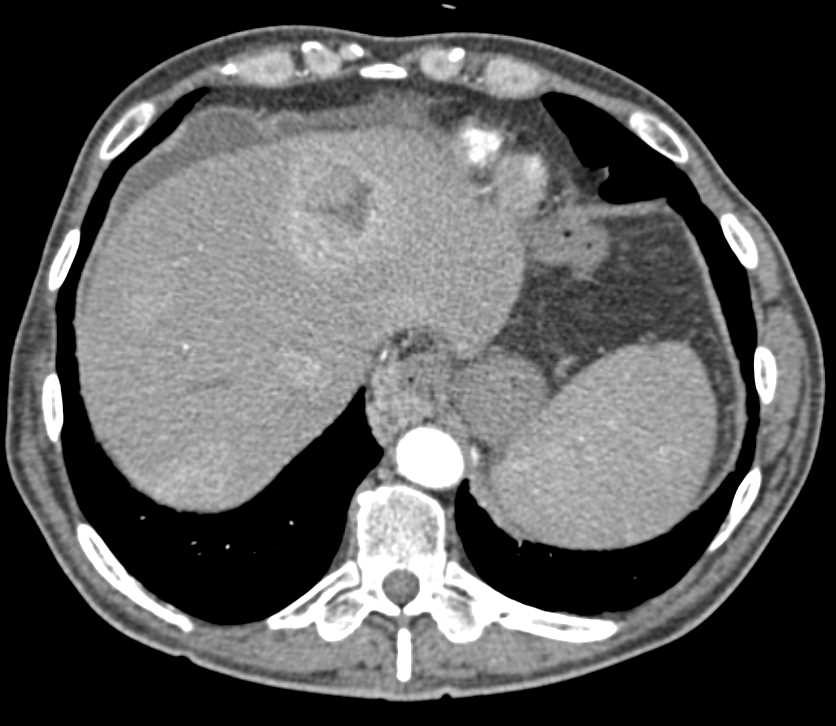 Recurrent Renal Cell Carcinoma in Surgical Bed and to the Liver, Pancreas and Nodes - CTisus CT Scan