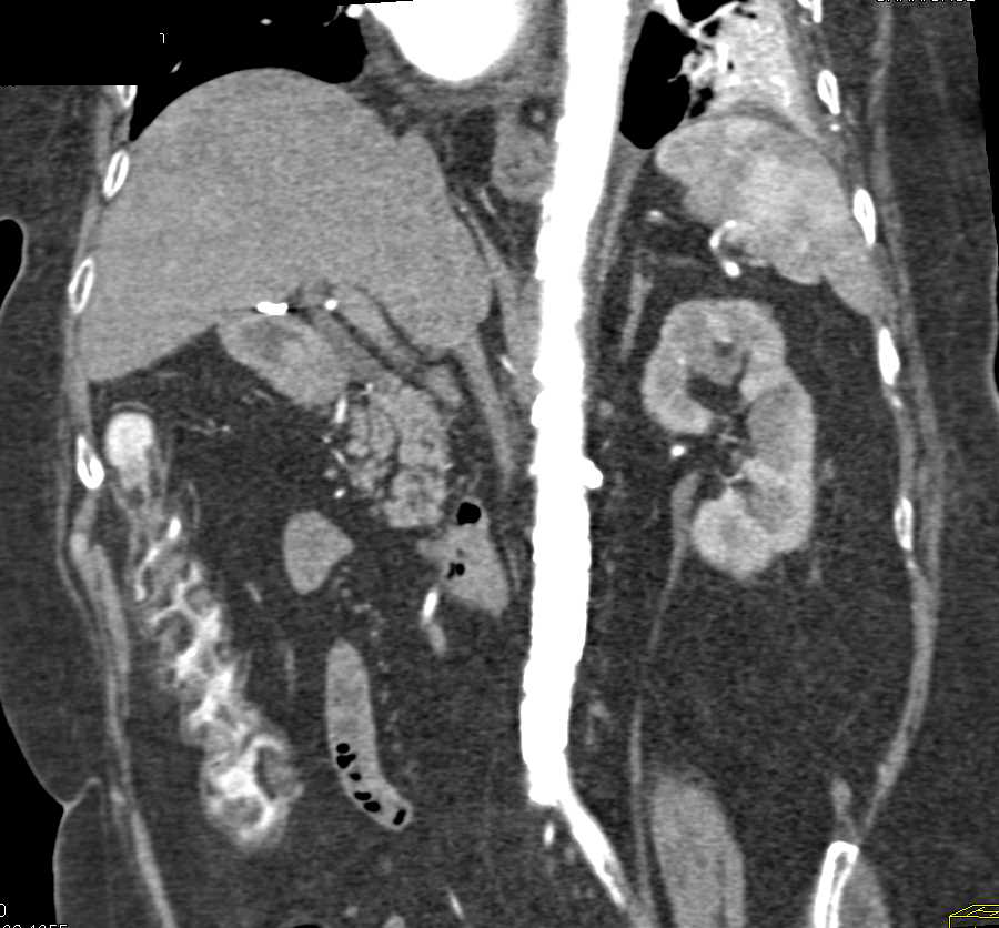 Surgical Changes S/P Right Nephrectomy - CTisus CT Scan