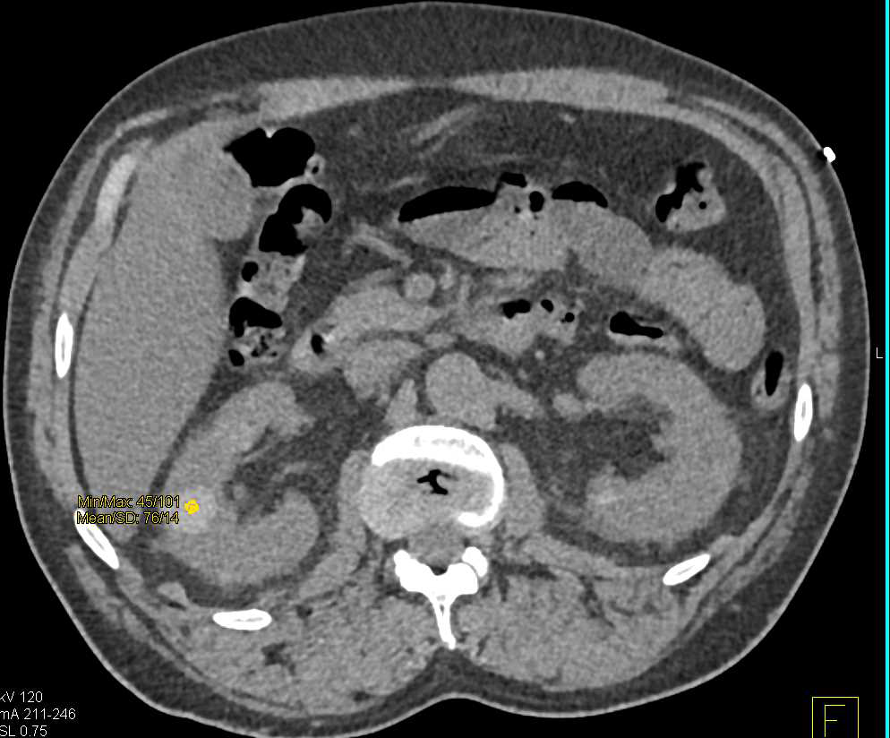 High Density Renal Cysts and Celiac Artery Dissection - CTisus CT Scan