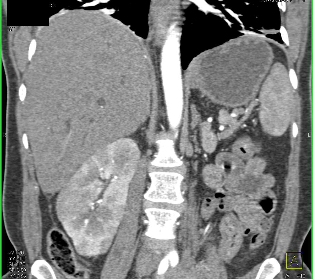 Metastatic Renal Cell Carcinoma to Contralateral Kidney and Pancreas and Liver - CTisus CT Scan