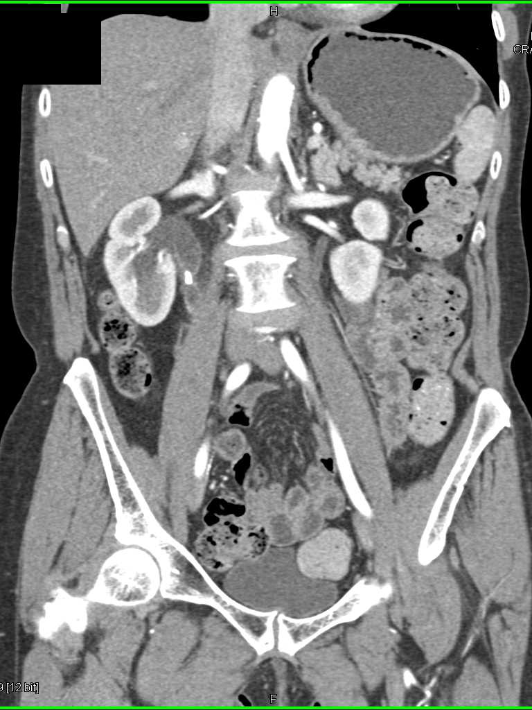 Obstructing Stone Right Ureter with Inflamed Right Ureter - CTisus CT Scan