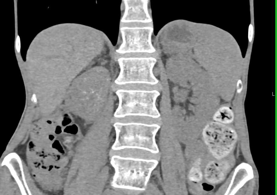 Recurrent Right Renal Cell Carcinoma with Spread Locally and to Nodes - CTisus CT Scan