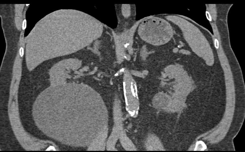 Bosniak I Cyst Right Kidney - CTisus CT Scan