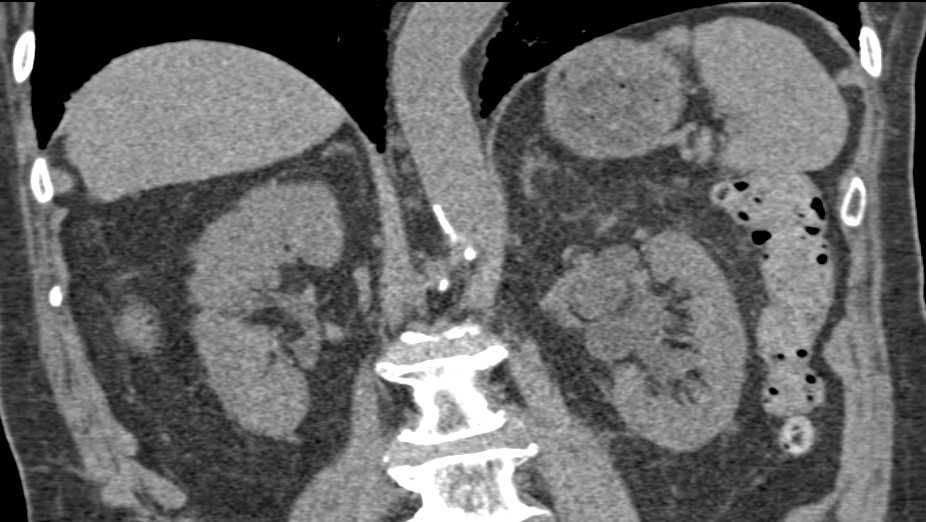 Tumor in Distal Left Ureter - CTisus CT Scan