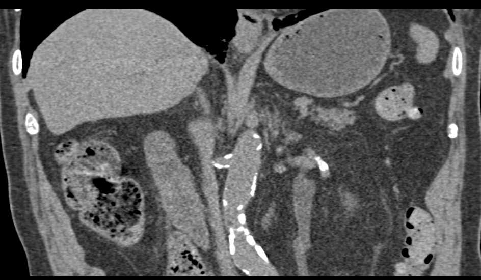 Tumor in Distal Left Ureter at Ureterovesical Junction (UVJ) - CTisus CT Scan