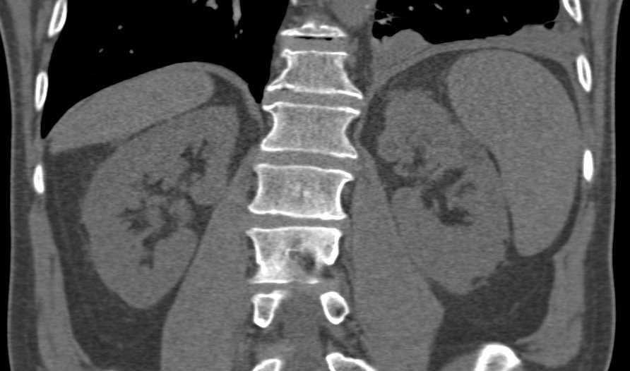 Lung Cancer Metastatic to the Upper Pole of the Left Kidney - CTisus CT Scan