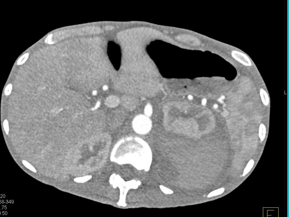 Left Perirenal Hematoma in a Patient with Myeloma - CTisus CT Scan