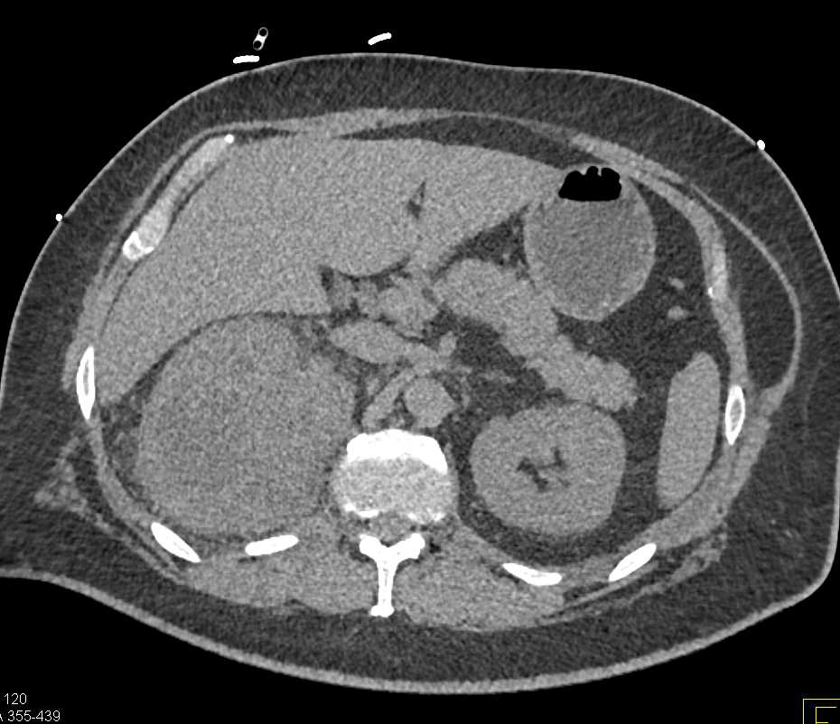 Transitional Cell Carcinoma Right Kidney - CTisus CT Scan