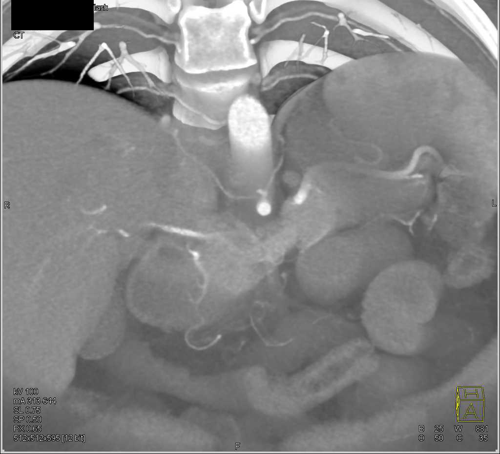 Necrotic Renal Cell Carcinoma Extends into the Left Adrenal Bed - CTisus CT Scan